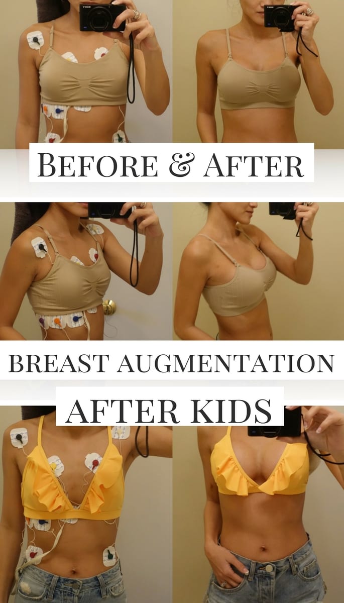 breast augmentation, 400 cc, before and after implants, silicone implants, high profile implants, boob job, breast implants, breast enlargements, breast augmentation after kids, breast feeding after breast augmentation 